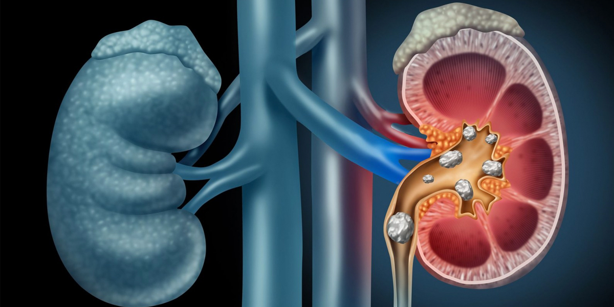 Kidney Stones – Symptoms and Treatment & Surgery Hospital in Chandigarh