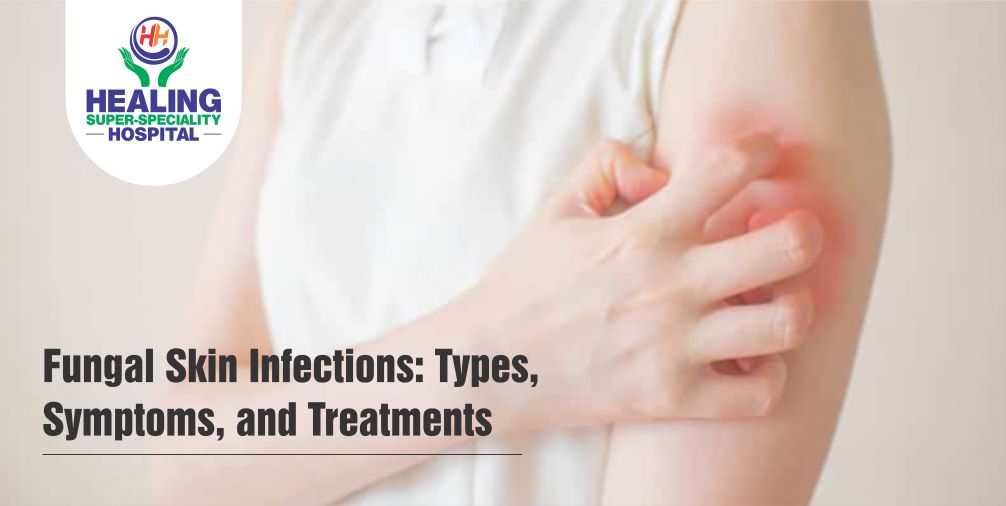 FUNGAL SKIN INFECTIONS TYPES SYMPTOMS AND TREATMENTS