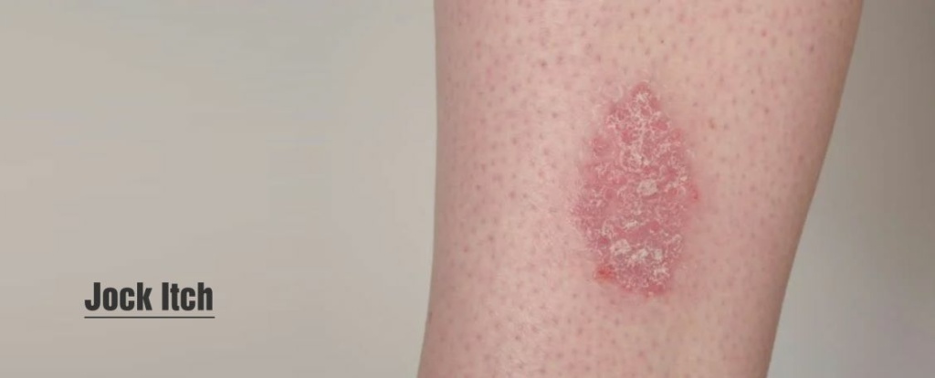 fungal skin rash