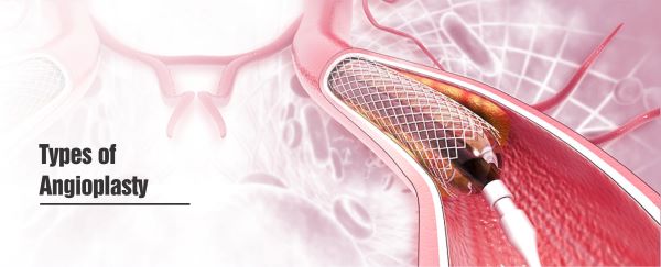 Angioplasty – Types, Risks, Recovery and Procedure - Healing Hospital