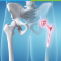 What are the Signs of Needing a Hip Replacement