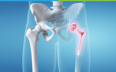 Hip Replacement Treatment in Chandigarh
