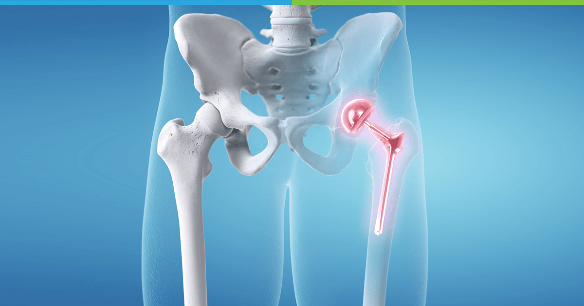Hip Replacement Treatment in Chandigarh