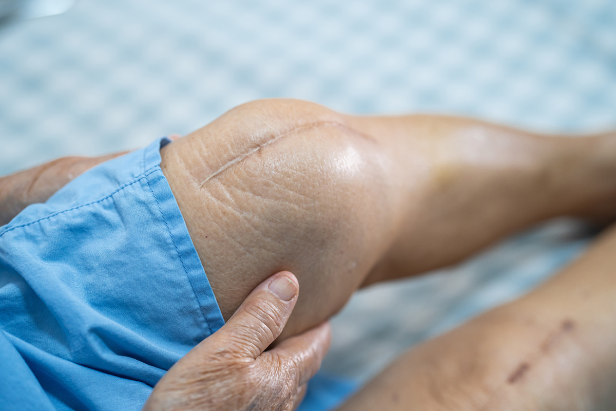 Knee Replacement Surgery Cost in Chandigarh, Mohali Punjab
