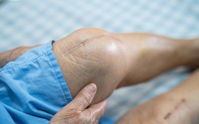 Knee Replacement Surgery Cost in Chandigarh, Mohali Punjab