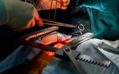 Heart Bypass Surgery in Chandigarh