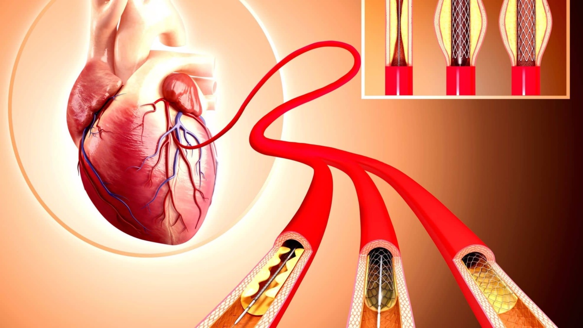 Heart Stenting Surgery Cost in Chandigarh