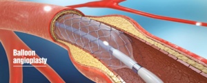 Balloon Angioplasty Cost in Chandigarh