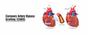 Healing Hospital Chandigarh Heart bypass in chandigarh