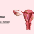 What Are Uterine Fibroids? (Causes, Symptoms and Treatment)