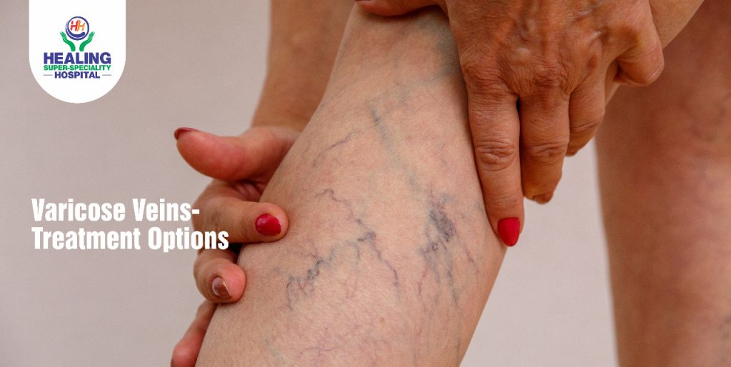 Varicose Veins-Treatment Options