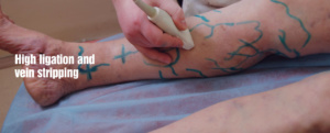 Varicose Veins-Treatment Options