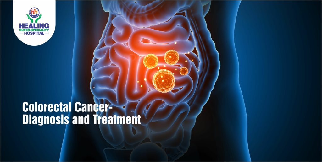 Colorectal Cancer