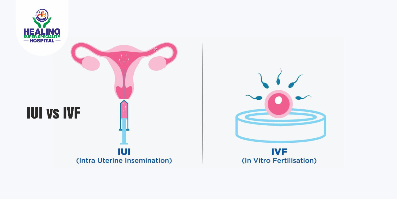 IUI vs IVF