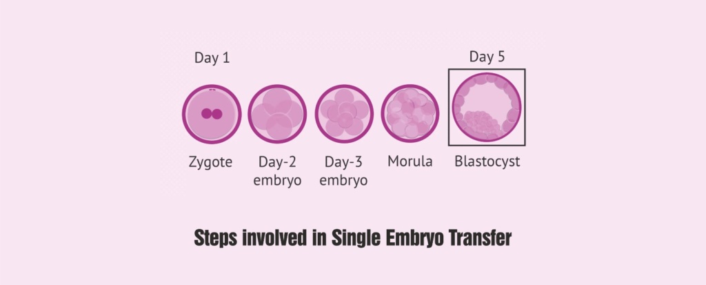 Steps involved in Single Embryo Transfer Healing Topic Image 1