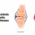 Rheumatoid Arthritis VS Osteoarthritis: Know The Difference