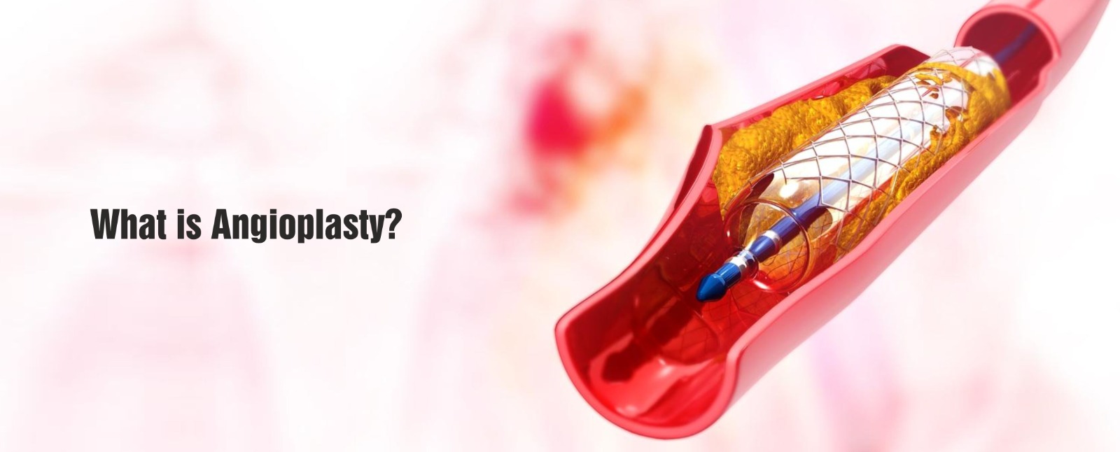 Risks And Complications Of Angioplasty What You Need To Know Risks And