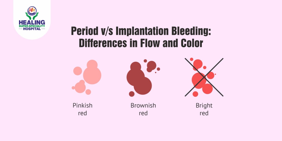 Period v/s Implantation Bleeding: Differences in Flow and Color