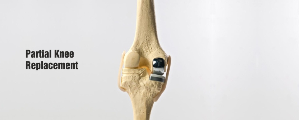 Total Knee Replacement in Chandigarh