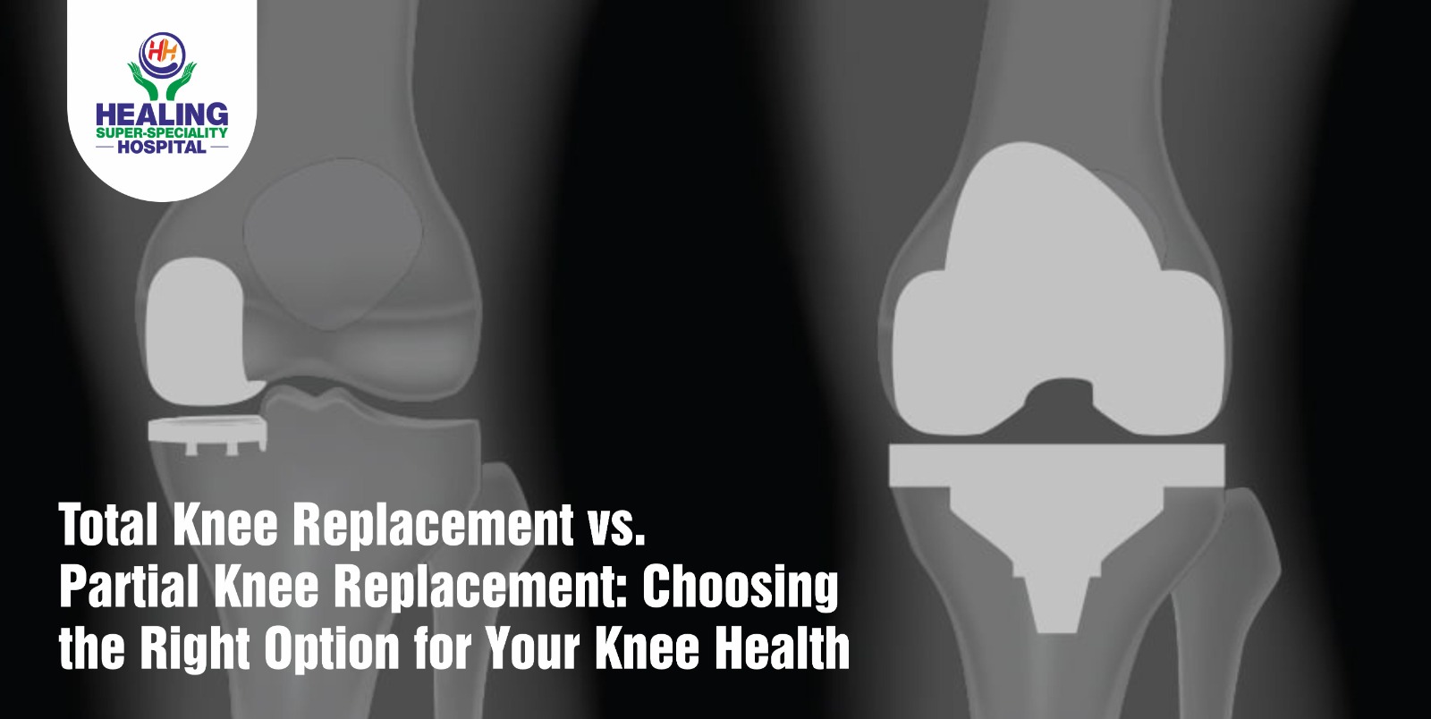 Total Knee Replacement vs. Partial Knee Replacement: Choosing the Right Option for Your Knee Health