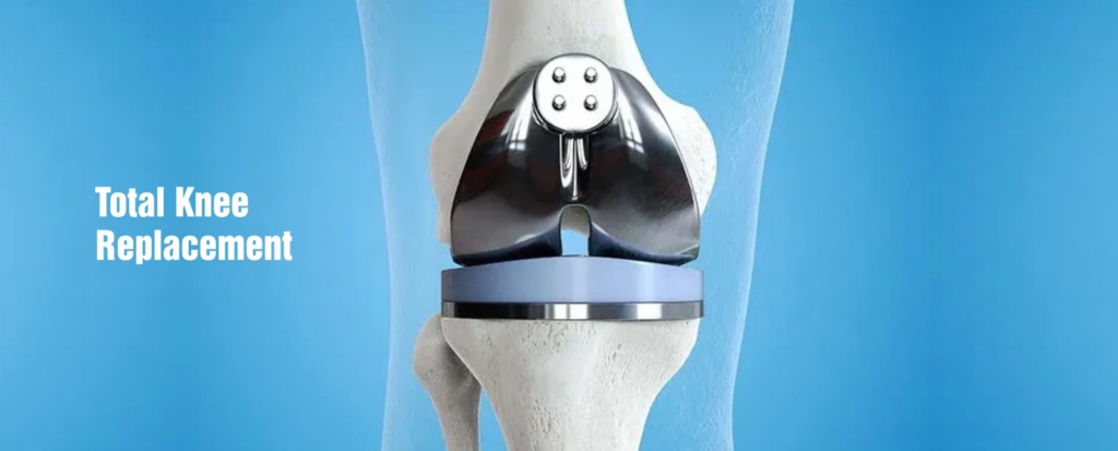 Total Knee Replacement in Chandigarh