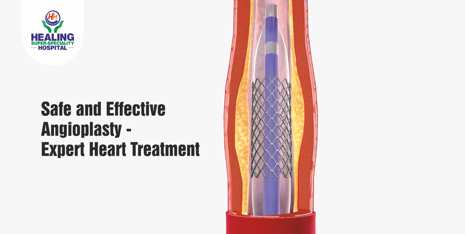 Safe and Effective Angioplasty – Expert Heart Treatment