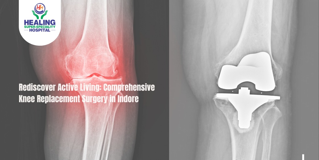 Rediscover Active Living: Comprehensive Knee Replacement Surgery in Indore