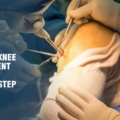 Choosing the Right Knee Replacement Surgeon: A Crucial Step