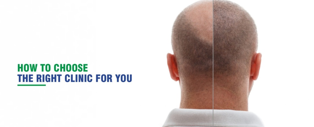 Best hair transplant in chandigarh