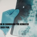 Best Spine Surgeon in Chandigarh for Herniated Disc, Scoliosis & Back Pain