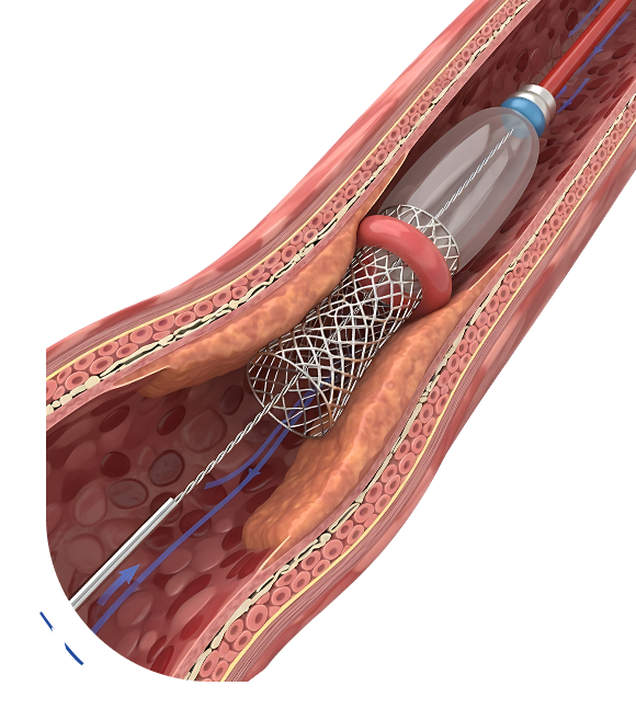 Why Choose Healing Hospital in Chandigarh for Angioplasty