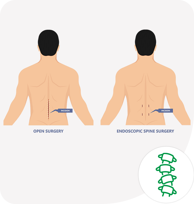 Endoscopic Spine Surgery in Chandigarh