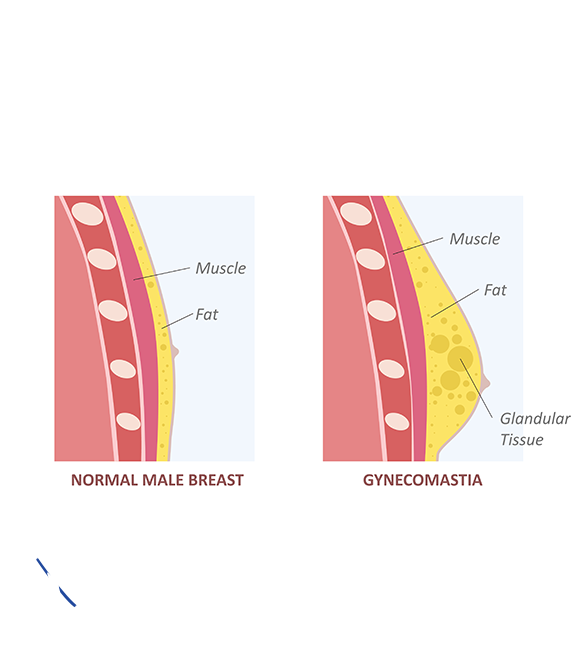 Why Choose Healing Hospital in Chandigarh for Gynecomastia Surgery