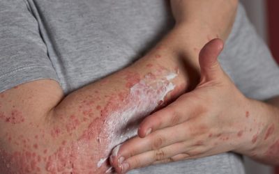 Heat Rash in Summer: Signs, Remedies & Prevention Tips