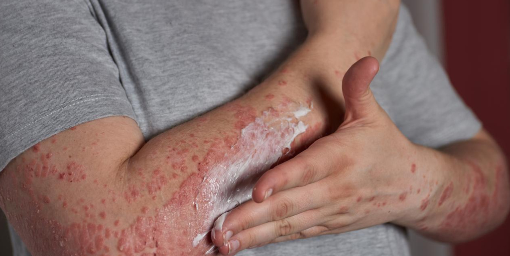 Heat Rash in Summer: Signs, Remedies & Prevention Tips
