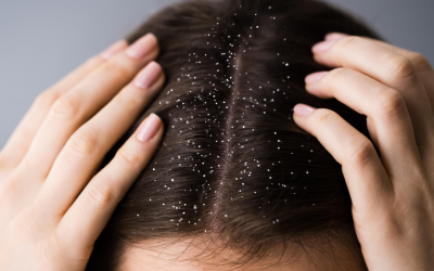 Dandruff-and-Itchy-Scalp