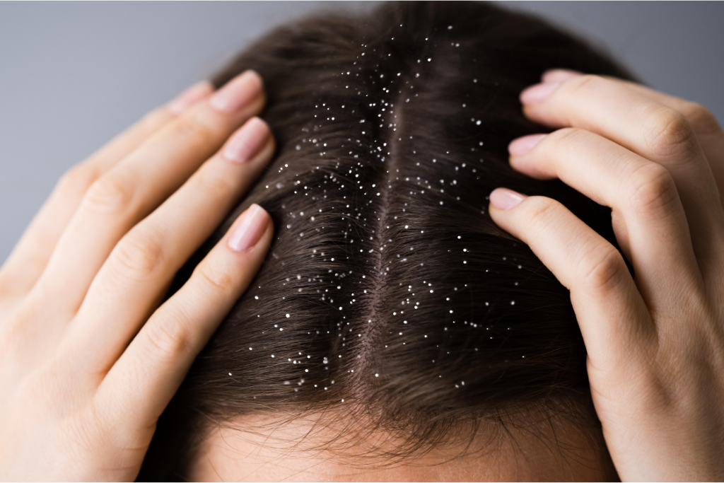 Dandruff-and-Itchy-Scalp