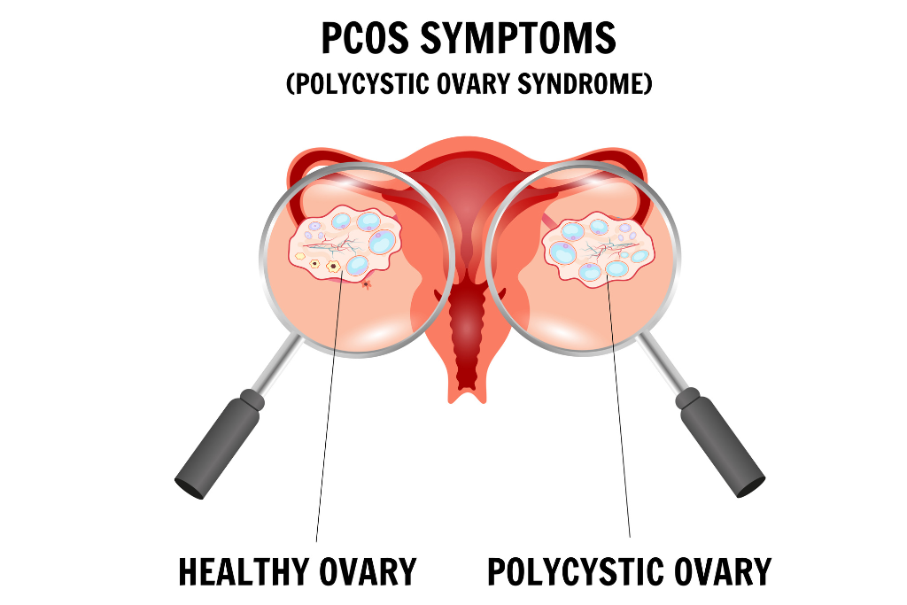 PCOS Symptoms Every Woman Should Know