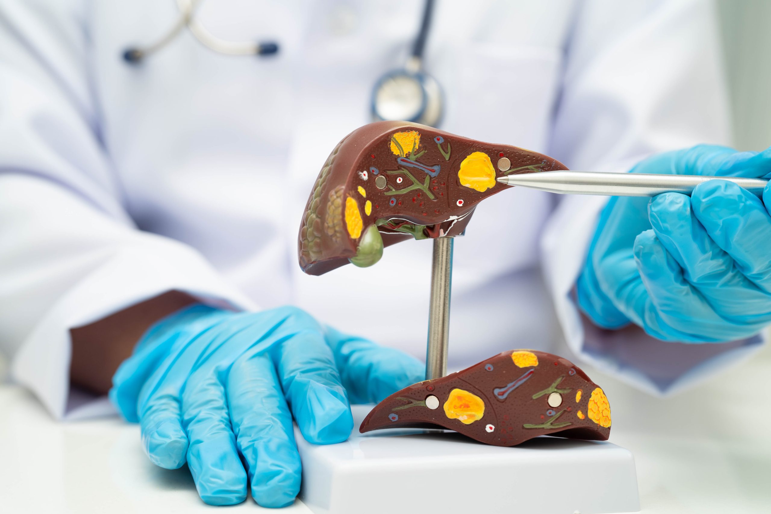 Silent Fatty Liver Symptoms That Can Affect Your Health