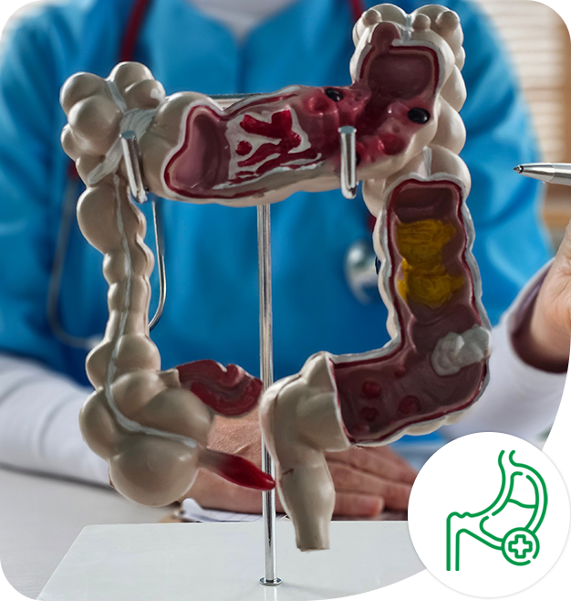 inflammator-bowel-disease